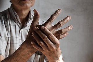 arthritis hands