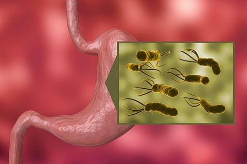 stomach infection h. pylori