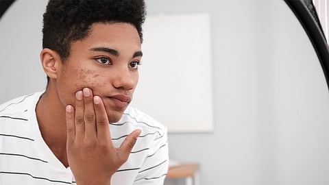 Young man with acne