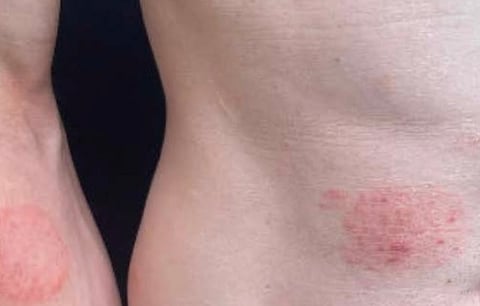 Typical round ringworm rash as seen on one of the patients