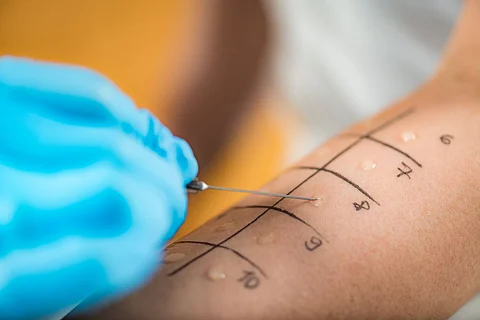 allergy allergies skin prick test