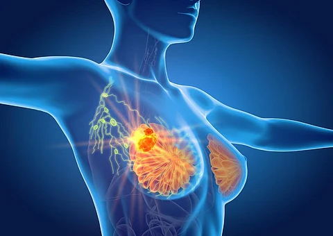 breast cancer lymph nodes
