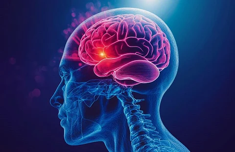 stroke brain