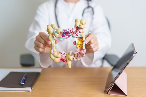 Photo of a doctor holding a 3D model of a colon