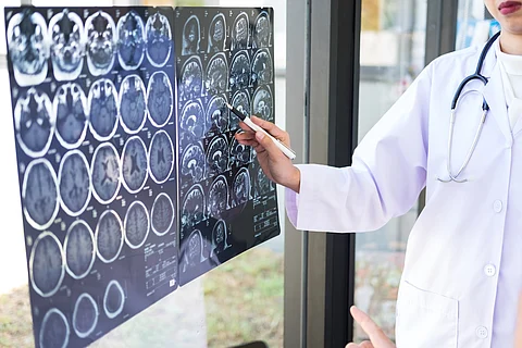 Nuevo fármaco anticoagulante más rápido e igual de eficaz en el tratamiento de los accidentes cerebrovasculares