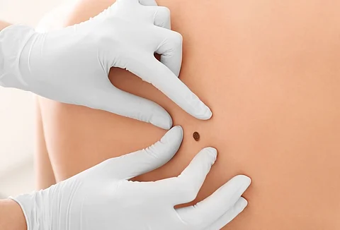 Un análisis de sangre puede predecir la recurrencia del melanoma