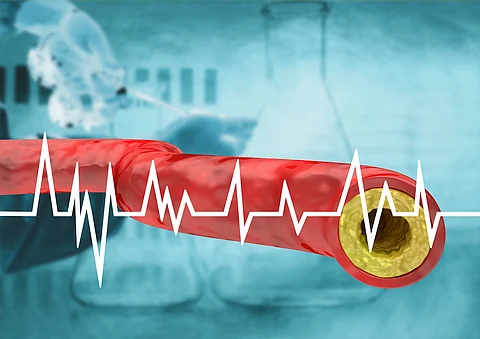 El sistema de puntuación puede evitar cirugías innecesarias para arterias obstruidas