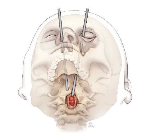 Ilustración de la vía quirúrgica transorbitaria al cordoma espinal