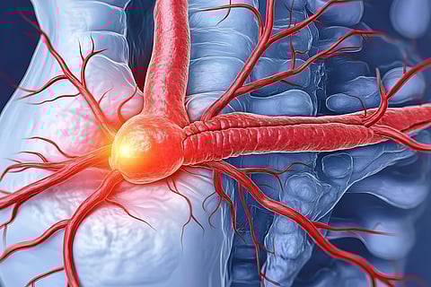 La carne roja podría aumentar el riesgo de aneurisma abdominal potencialmente mortal