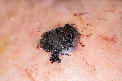 Una prueba genética podría evitar la biopsia para algunos pacientes con melanoma