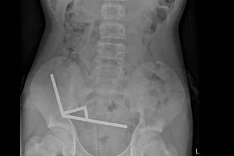 Abdominal X-ray with four linear chains of magnets in the right lower quadrant.