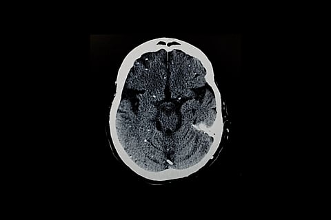 TAC cerebral con cisticercosis - Larvas calcificadas de tenia porcina