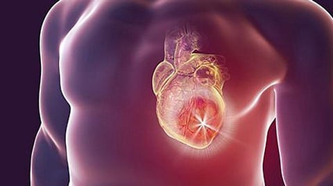 Clasifican al infarto cardiaco en cuatro etapas con base en el daño del tejido del miocardio