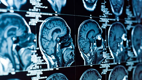 Una parte de tu cerebro podría indicar el declive de la mente
