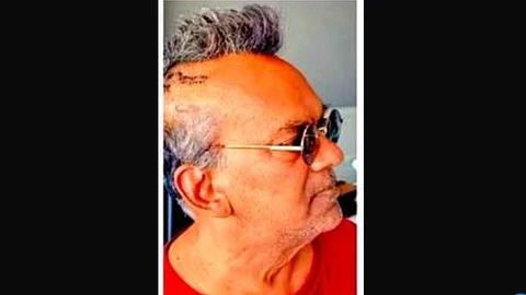 Remo Fernandes Recovers After Burr Hole Surgery, Jokes About ‘Hardcore Punk’ Look