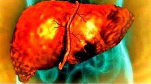 Goa Reports 27 Liver Cirrhosis Deaths Monthly; Surge in Cases Among Middle-Aged Sparks Health Alarm