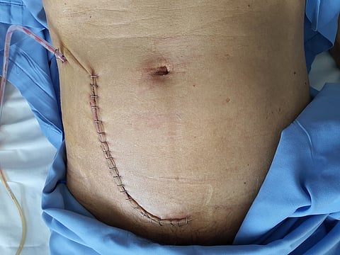 Wound image of a patient undergoing kidney transplantation on a hospital bed.