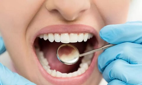 अध्ययन से पता चलता है कि सीलिएक रोग के रोगियों में दांतों के इनेमल को नुकसान क्यों होता है