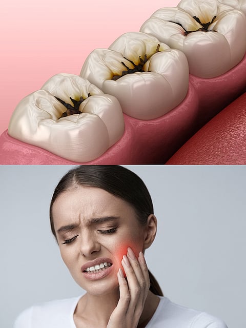 Tooth decay and Solution health tips