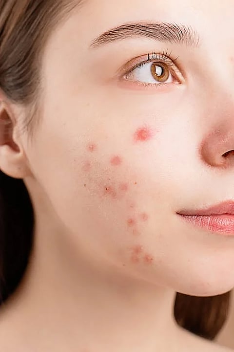 To prevent acne - some important tips