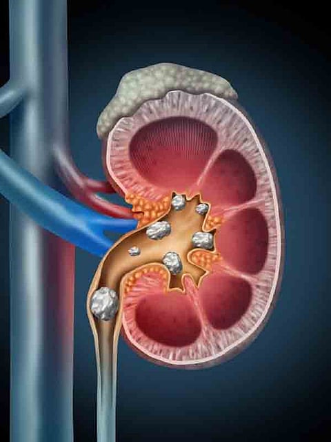 How to dissolve kidney stones naturally