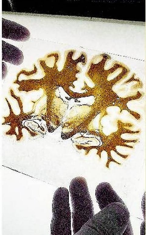 பக்கவாதம் தடுப்பது எப்படி?