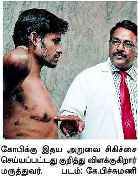 தொழிலாளிக்கு இதய வால்வு மாற்று அறுவை சிகிச்சை: அரசுப் பொது மருத்துவமனை மருத்துவர்கள் சாதனை