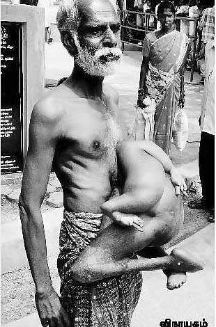 54 ஆண்டுகளாக வயிற்றில் கை, கால்களுடன் அதிசய மனிதர்: மருத்துவ சிகிச்சை கோரி ஆட்சியரிடம் மனு