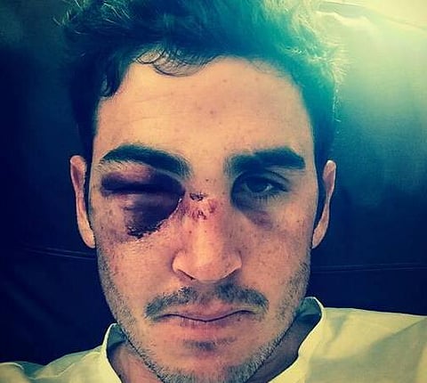 பயங்கர பவுன்சரில் முகம் பெயர்ந்த இங்கிலாந்து பேட்ஸ்மென் கீஸ்வெட்டர்