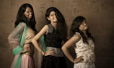 ஆசிட் வீச்சால் பாதிக்கப்பட்ட பெண்களின் புகைப்படத் தொகுப்பு: பரவலான கவனத்தை ஈர்க்கிறது