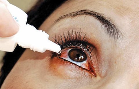 மழைக்காலத்தில் பரவும் மெட்ராஸ் ஐ: ஒரு மாதத்தில் 3 ஆயிரம் பேர் பாதிப்பு