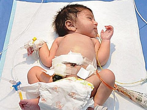 பிறந்து 6 நாளே ஆன சிசுவுக்கு அறுவை சிகிச்சை: தருமபுரி அரசு மருத்துவமனையில் சாதனை