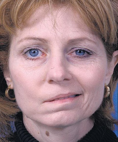 பெண்களைத் தாக்கும் முகவாதம் - மார்கழி முன்னெச்சரிக்கை