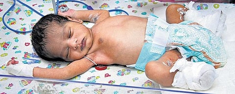 குழந்தை உடலில் தானாக தீக்காயங்கள் ஏற்படவில்லை: உண்மையை கண்டுபிடிக்க போலீஸ் விசாரணை