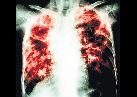 யாருக்கு வரும் உருக்குலைக்கும் நோய்?- காசநோய் விழிப்புணர்வு