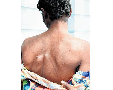 முதுகு தண்டில் வைக்கப்பட்ட பிளேட் வெளியே வந்ததால் அவதிப்படும் இளைஞர்: உதவி கோரி முதல்வர் தனிப்பிரிவில் மனு