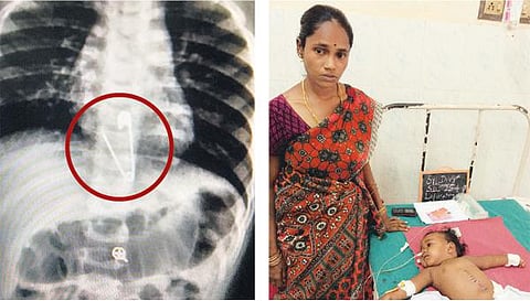 எழும்பூர் அரசு குழந்தைகள் நல மருத்துவமனையில் 10 மாத பெண் குழந்தையின் உணவுக்குழாயில் சிக்கிய ஊக்கு: அறுவை சிகிச்சை செய்து அகற்றம்