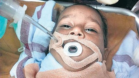 விபத்தில் சிக்கி உயிருக்கு போராடிய குழந்தையை 25 டாக்டர்கள் 8 மணி நேரம் போராடி காப்பாற்றினர்: எழும்பூர் அரசு குழந்தைகள் நல மருத்துவமனை சாதனை