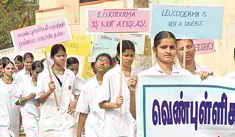 வெண்புள்ளிகளுக்கு முற்றுப்புள்ளி!