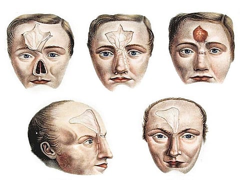 பிளாஸ்டிக் சர்ஜரியின் வரலாறு