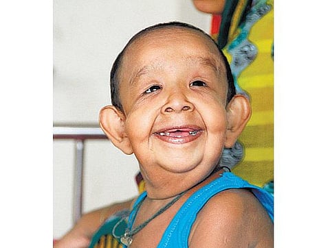 வங்கதேசத்தில் 4 வயது சிறுவனுக்கு முதுமை