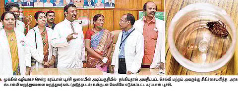 தூங்கிக்கொண்டிருந்த பெண்ணின் மூக்கில் புகுந்து மூளை வரை சென்ற கரப்பான்பூச்சி: ஸ்டான்லி மருத்துவர்கள் உயிருடன் அகற்றினர்