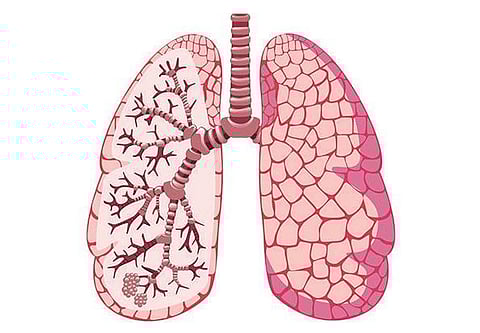 உடல் பருமனால் 8.8 சதவீதம் பேருக்கு ஆஸ்துமா: குழந்தைகளுக்கும் அதிகளவில் பரவுவதாக அதிர்ச்சி தகவல்