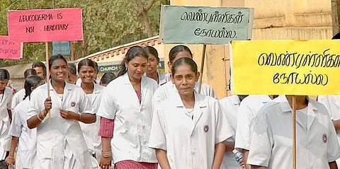 வெண்புள்ளிகள் எனும் குறைபாட்டை வெல்வோம்!