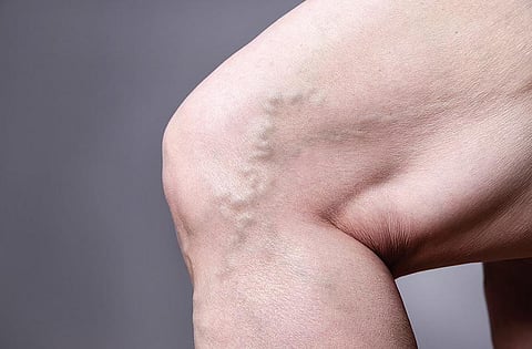 நலம், நலமறிய ஆவல் 47: சிரை நோயிலிருந்து விடுதலை?