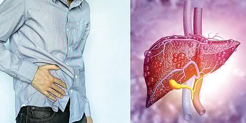 நலம், நலமறிய ஆவல் 51: கல்லீரலுக்குக் கல்லறை கட்டும் மன அழுத்தம்!