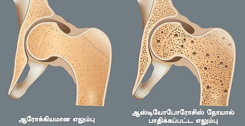 ‘எலும்பு வலுவிழப்பு நோய்’ வராமல் தடுப்பது எப்படி?