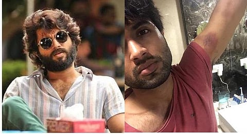 படப்பிடிப்பின் போது சிறிய விபத்து: கால் சறுக்கியதில் விஜய் தேவரகொண்டாவுக்கு காயம்