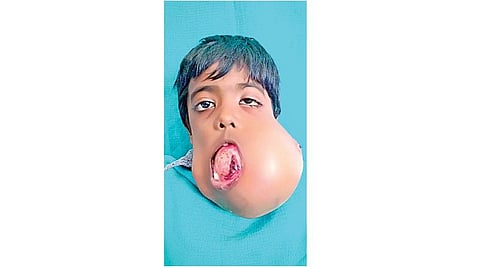 இந்தியாவில் முதல் முறையாக அறுவை சிகிச்சை மூலம் 7 வயது சிறுவனின் தாடையில் இருந்த 1.5 கிலோ கட்டி அகற்றம்: சென்னை அரசு பல் மருத்துவமனை சாதனை