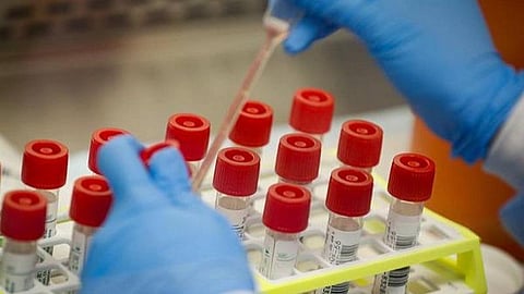 மதுரை ‘கரோனா’ ஆய்வு மையத்தில் 'சோதனை கிட்' இல்லை: முடிவை உடனடியாக அறிய முடியாமல் நோய் அறிகுறியுள்ளவர்கள் தவிப்பு